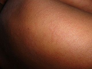 measles rashes